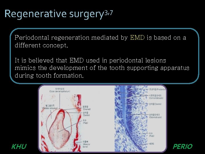 Regenerative surgery 3, 7 Periodontal regeneration mediated by EMD is based on a different Regenerative surgery 3, 7 Periodontal regeneration mediated by EMD is based on a different