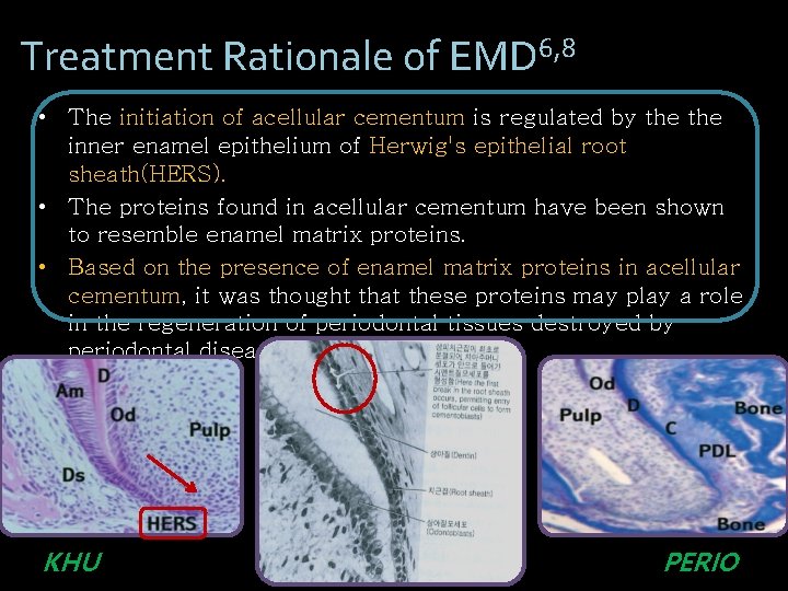 Treatment Rationale of EMD 6, 8 • The initiation of acellular cementum is regulated