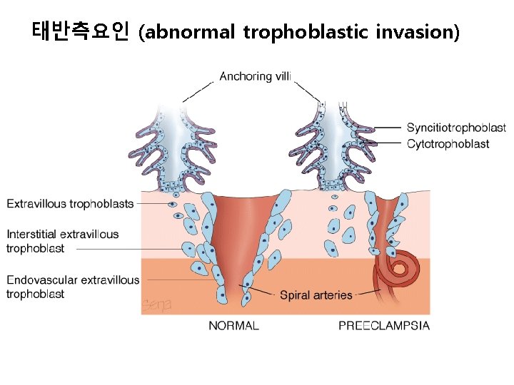 태반측요인 (abnormal trophoblastic invasion) 
