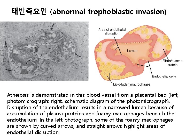 태반측요인 (abnormal trophoblastic invasion) Atherosis is demonstrated in this blood vessel from a placental