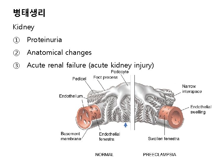 병태생리 Kidney ① Proteinuria ② Anatomical changes ③ Acute renal failure (acute kidney injury)