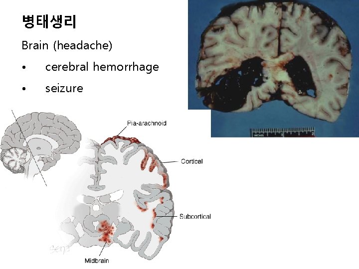 병태생리 Brain (headache) • cerebral hemorrhage • seizure 