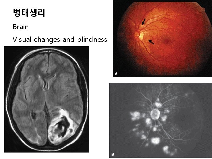 병태생리 Brain Visual changes and blindness 