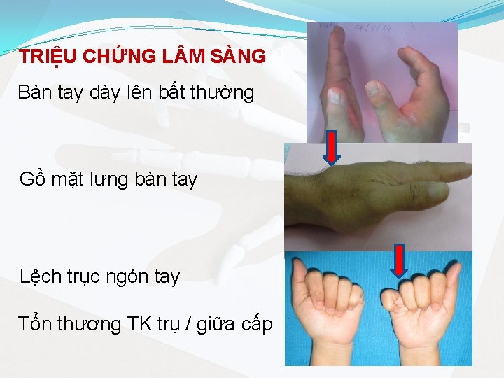 TRIỆU CHỨNG L M SÀNG Bàn tay dày lên bất thường Gồ mặt lưng