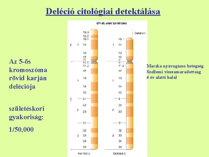 Deléció citológiai detektálása Az 5 -ös kromoszóma rövid karján deléciója születéskori gyakoriság: 1/50, 000