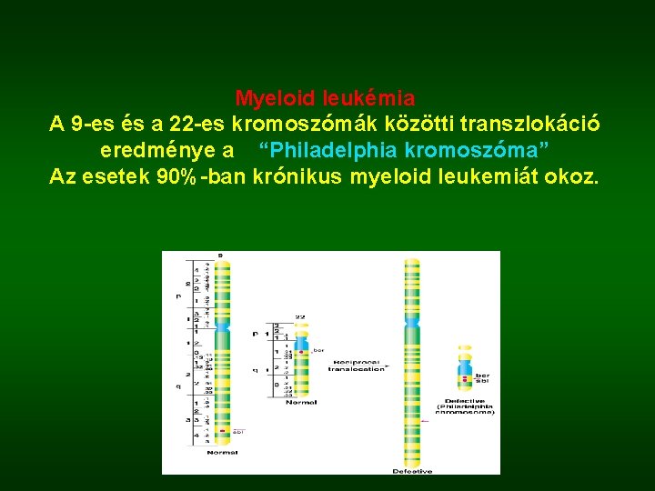 Myeloid leukémia A 9 -es és a 22 -es kromoszómák közötti transzlokáció eredménye a