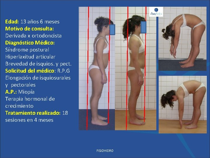 Edad: 13 años 6 meses Motivo de consulta: Derivada x ortodoncista Diagnóstico Médico: Síndrome