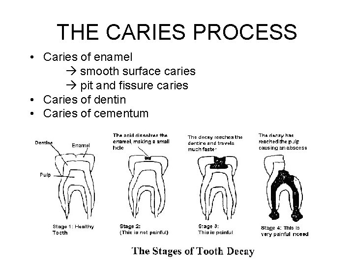 THE CARIES PROCESS • Caries of enamel smooth surface caries pit and fissure caries