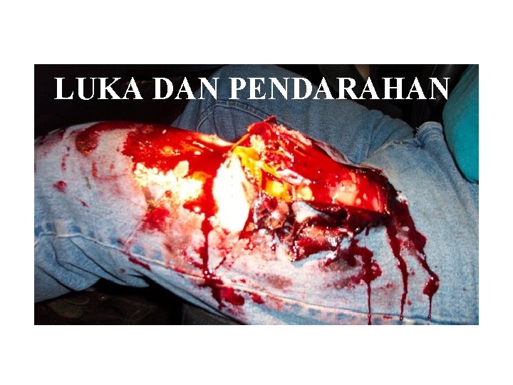 LUKA DAN PENDARAHAN 