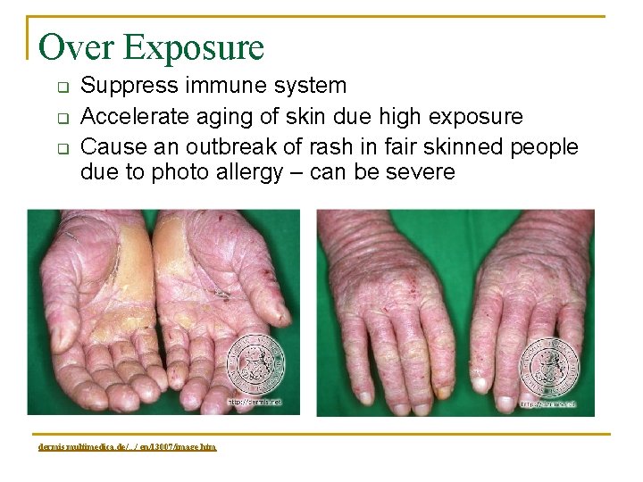 Over Exposure q q q Suppress immune system Accelerate aging of skin due high