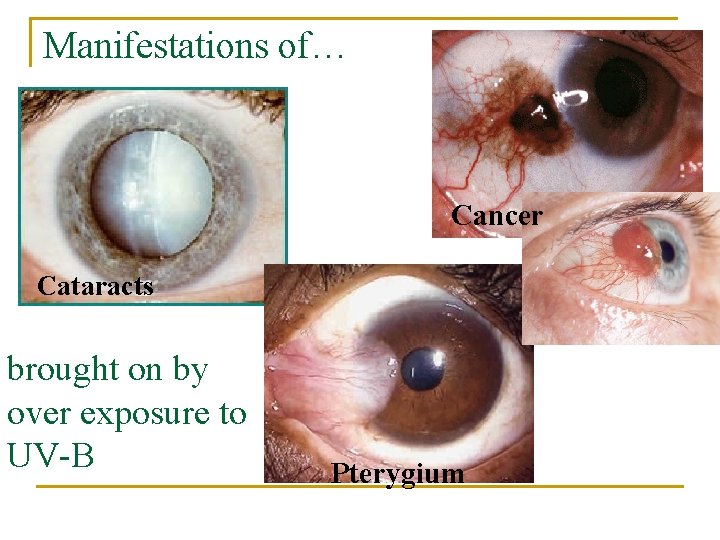 Manifestations of… Cancer Cataracts brought on by over exposure to UV-B Pterygium 