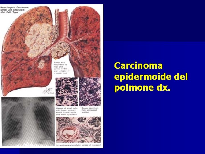 Carcinoma epidermoide del polmone dx. 