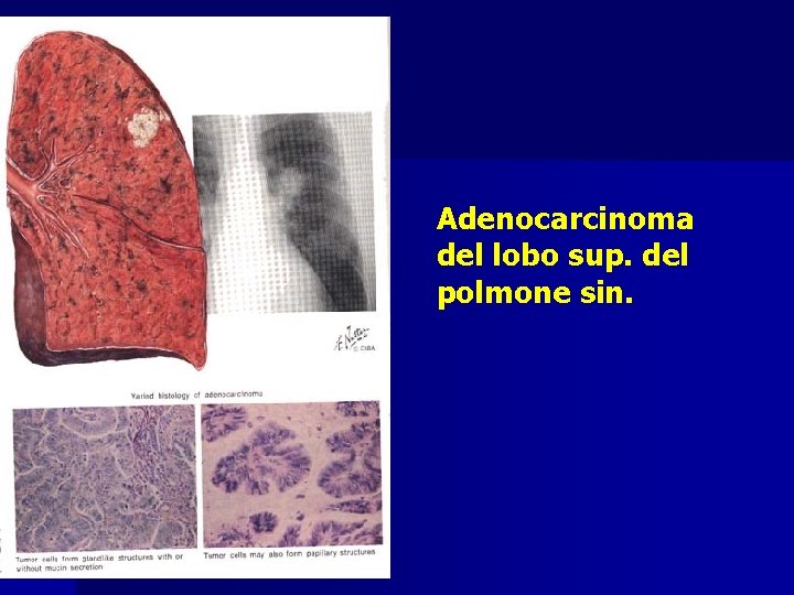 Adenocarcinoma del lobo sup. del polmone sin. 