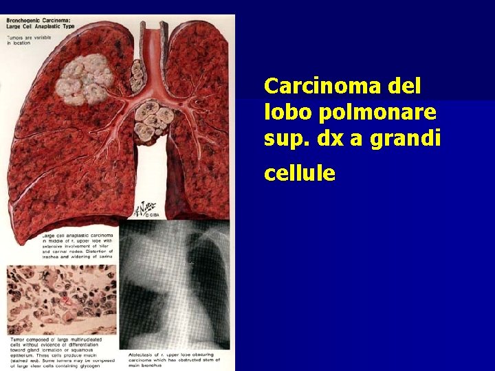 Carcinoma del lobo polmonare sup. dx a grandi cellule 