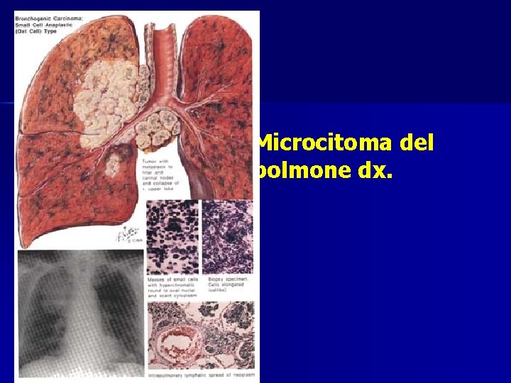 Microcitoma del polmone dx. 