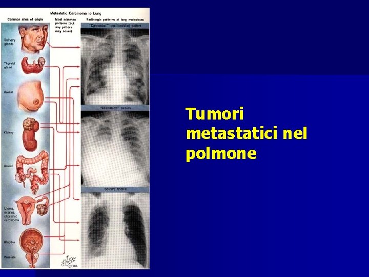 Tumori metastatici nel polmone 