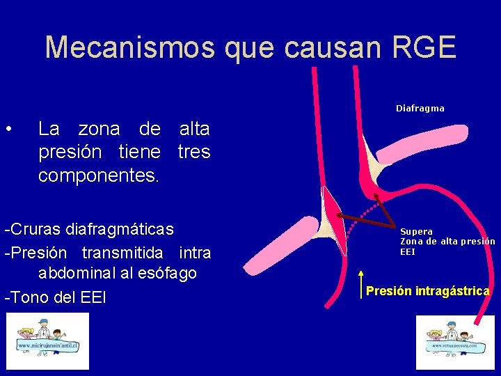 Mecanismos que causan RGE Diafragma • La zona de alta presión tiene tres componentes.