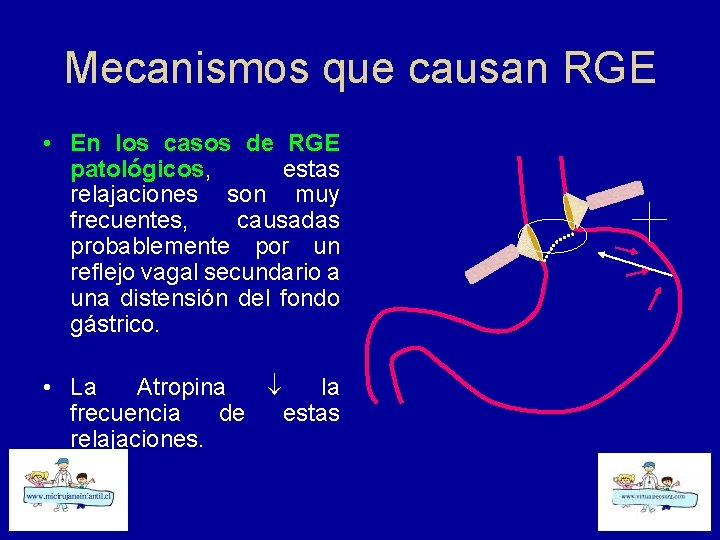 Mecanismos que causan RGE • En los casos de RGE patológicos, estas relajaciones son