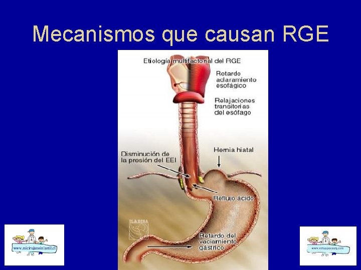 Mecanismos que causan RGE 