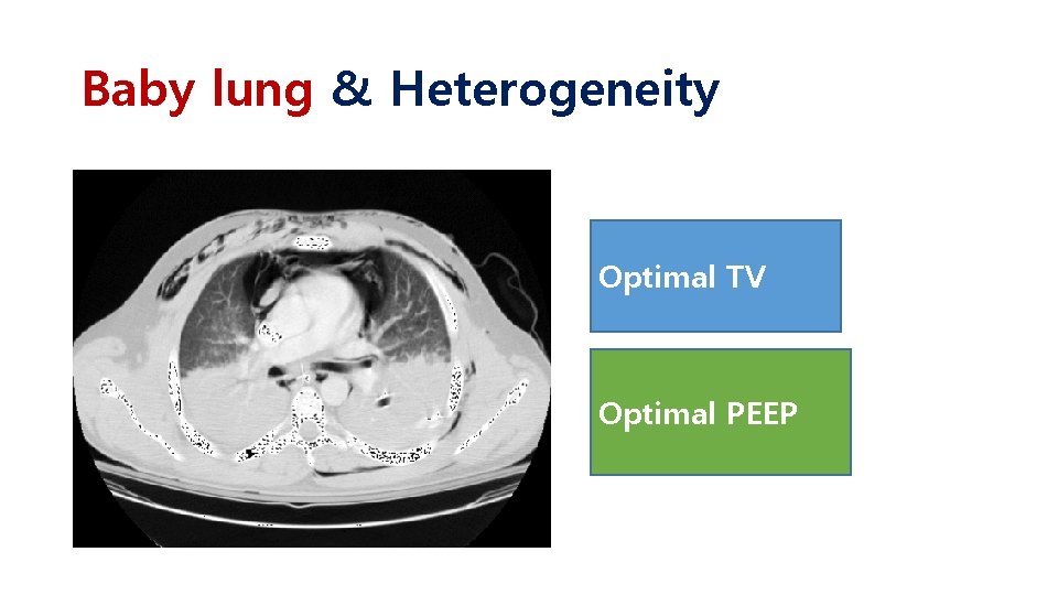 Baby lung & Heterogeneity Optimal TV Optimal PEEP 