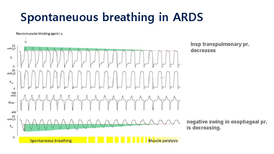 Spontaneuous breathing in ARDS Insp transpulmonary pr. decreases negative swing in esophageal pr. is