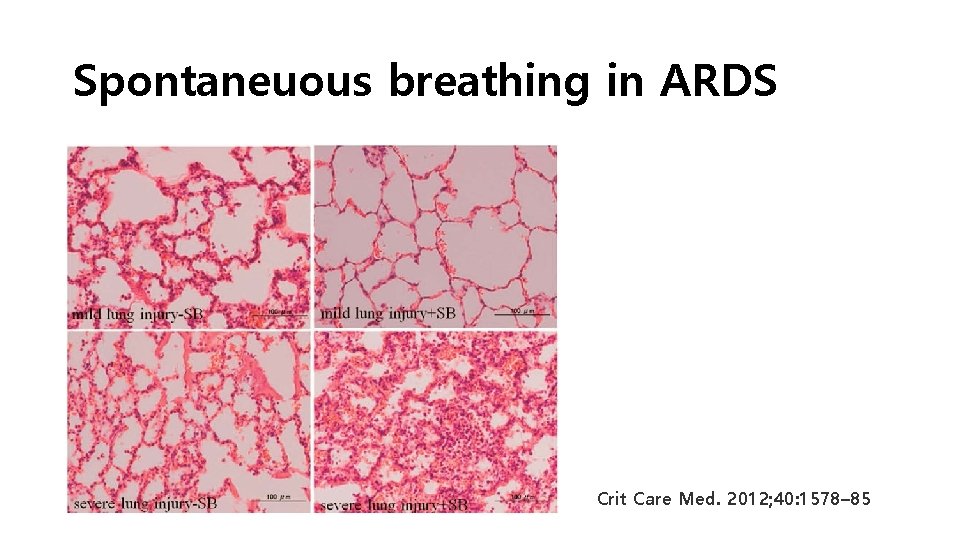 Spontaneuous breathing in ARDS Crit Care Med. 2012; 40: 1578– 85 