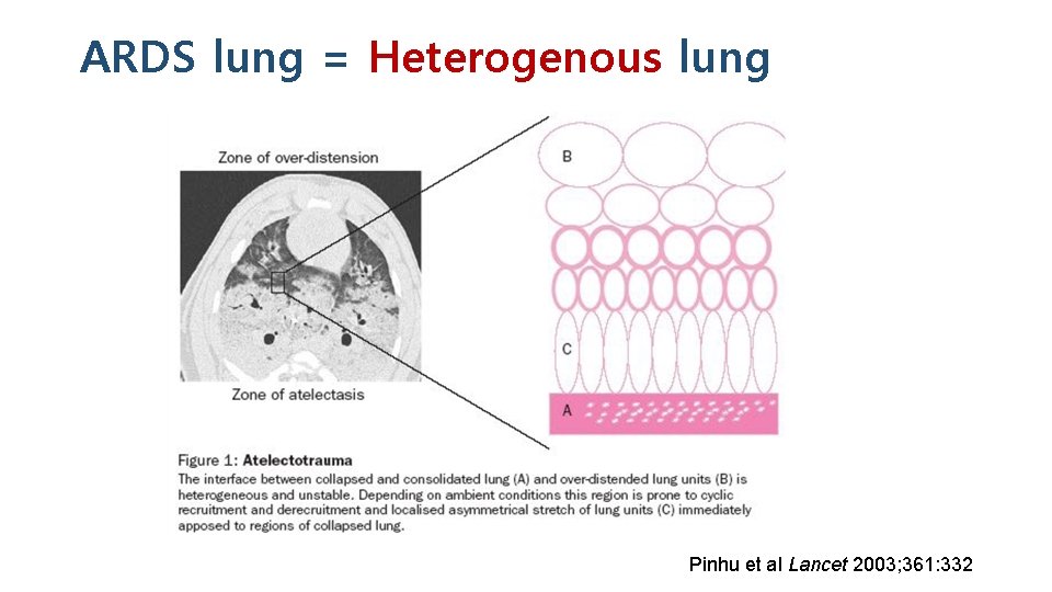 ARDS lung = Heterogenous lung Pinhu et al Lancet 2003; 361: 332 