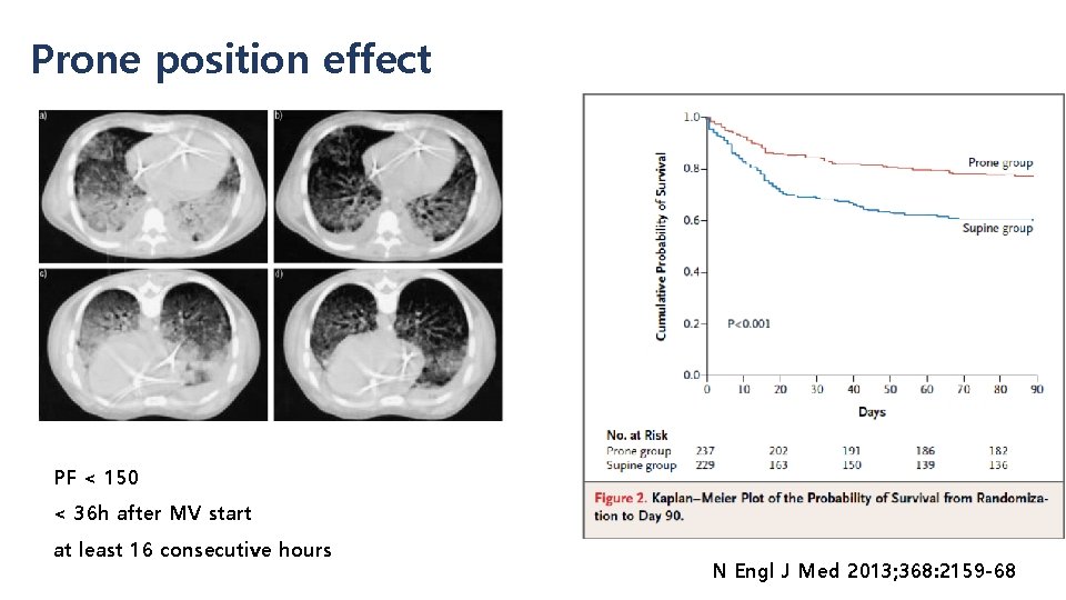 Prone position effect PF < 150 < 36 h after MV start at least