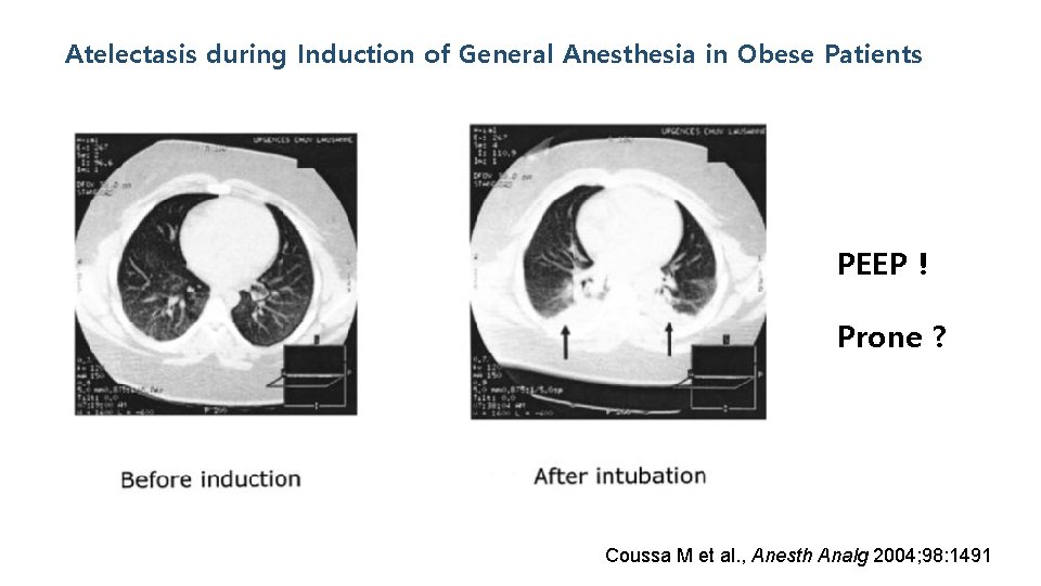 Atelectasis during Induction of General Anesthesia in Obese Patients PEEP ! Prone ? Coussa