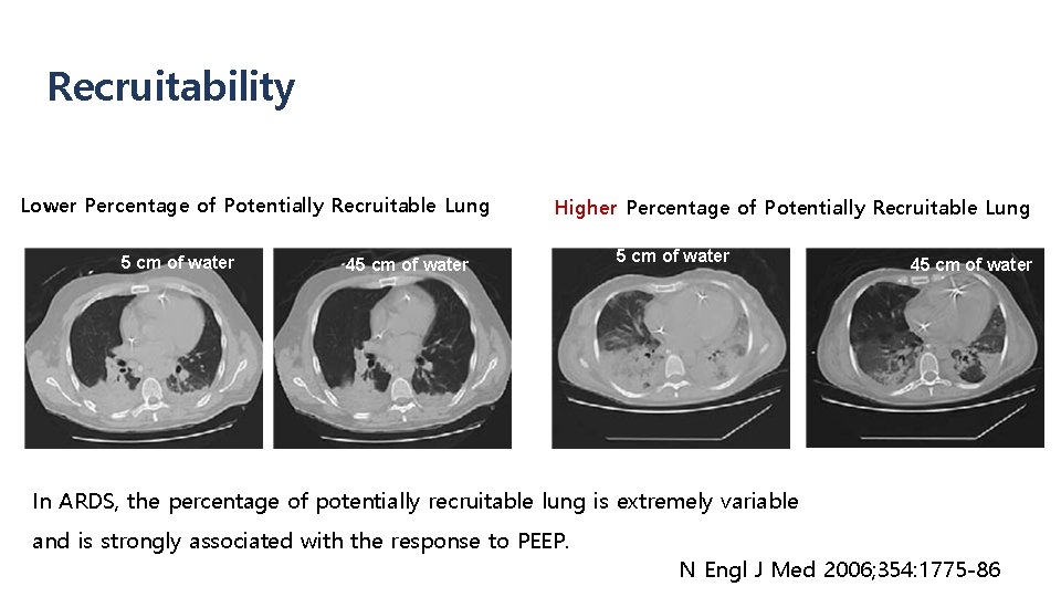 Recruitability Lower Percentage of Potentially Recruitable Lung 5 cm of water Higher Percentage of