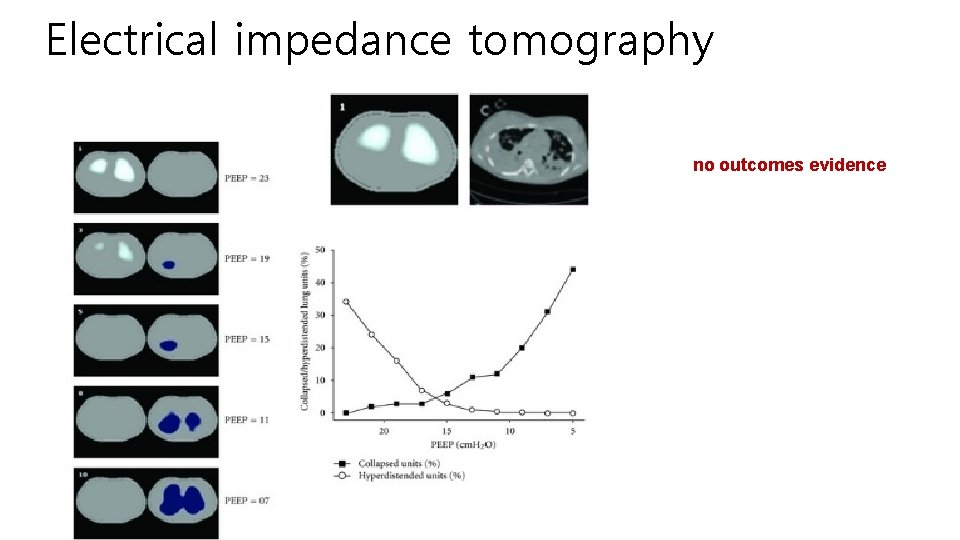 Electrical impedance tomography no outcomes evidence 