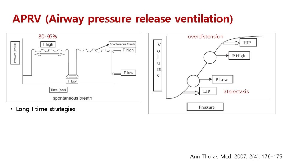 APRV (Airway pressure release ventilation) 80 -95% overdistension atelectasis • Long I time strategies