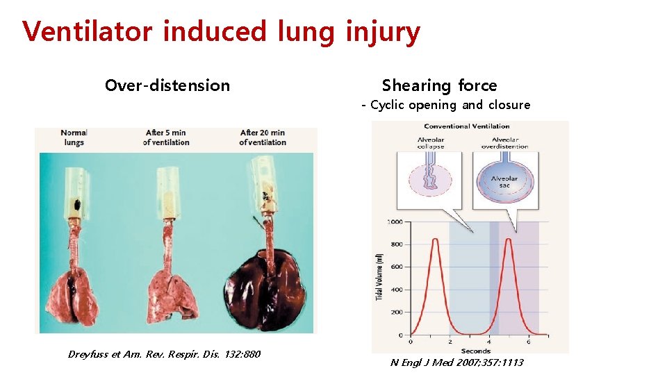 Ventilator induced lung injury Over-distension Shearing force - Cyclic opening and closure Dreyfuss et