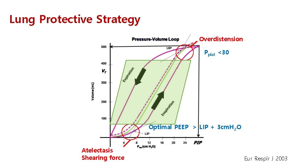 Lung Protective Strategy Overdistension Pplat <30 Optimal PEEP > LIP + 3 cm. H