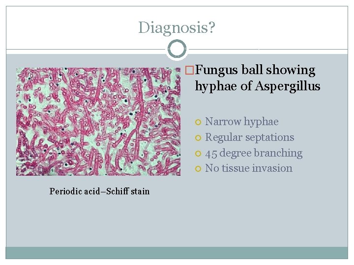 Diagnosis? �Fungus ball showing hyphae of Aspergillus Periodic acid–Schiff stain Narrow hyphae Regular septations
