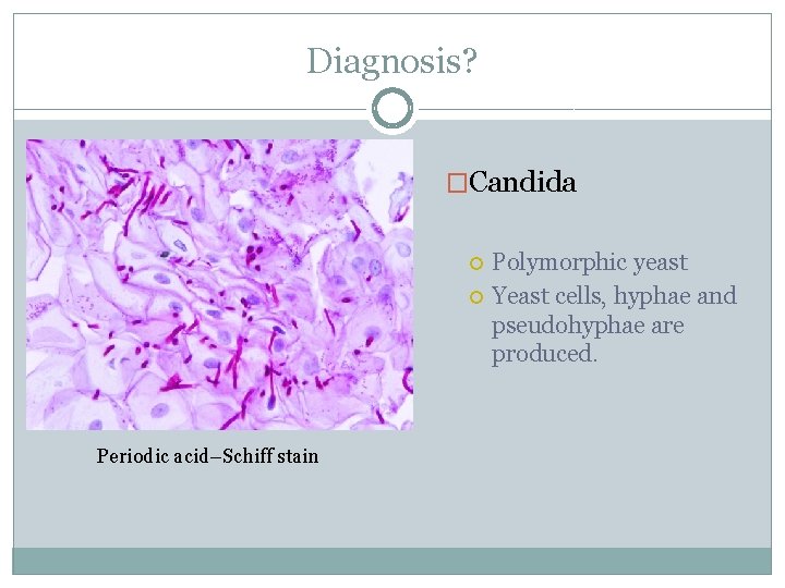 Diagnosis? �Candida Periodic acid–Schiff stain Polymorphic yeast Yeast cells, hyphae and pseudohyphae are produced.