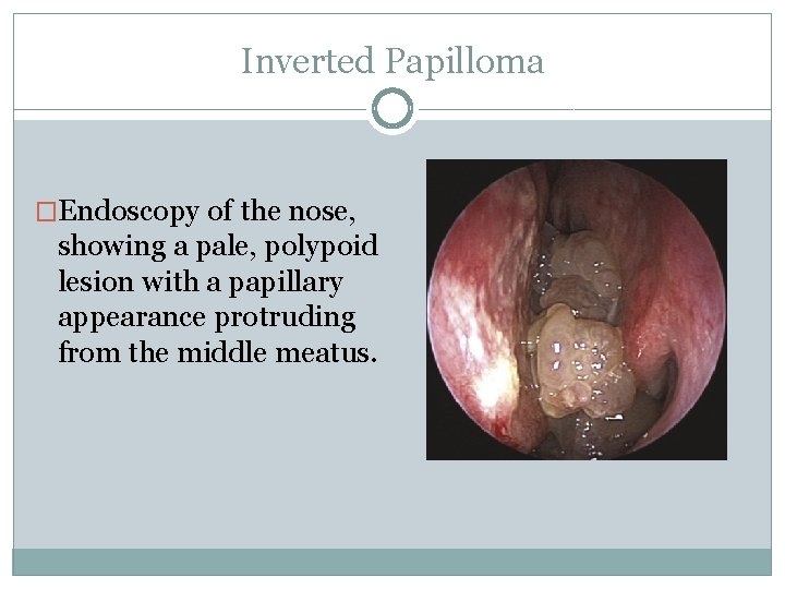 Inverted Papilloma �Endoscopy of the nose, showing a pale, polypoid lesion with a papillary