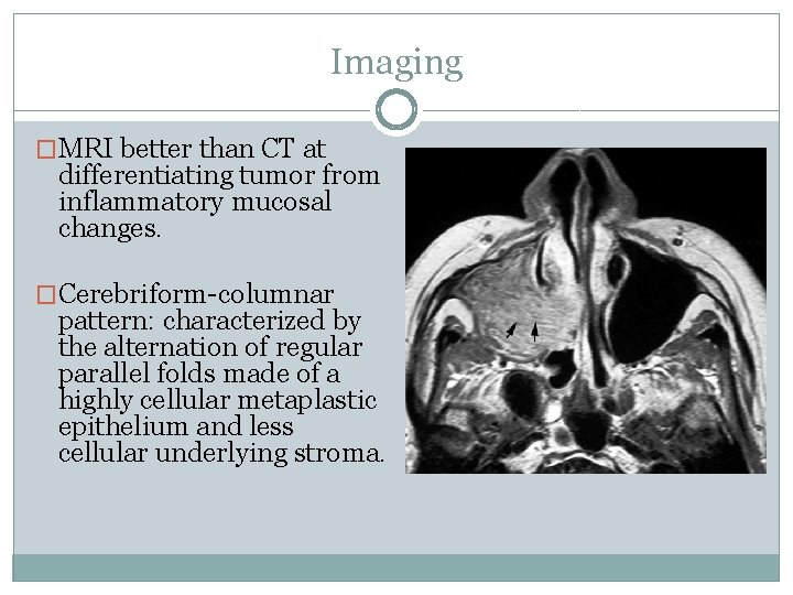 Imaging �MRI better than CT at differentiating tumor from inflammatory mucosal changes. �Cerebriform-columnar pattern: Imaging �MRI better than CT at differentiating tumor from inflammatory mucosal changes. �Cerebriform-columnar pattern: