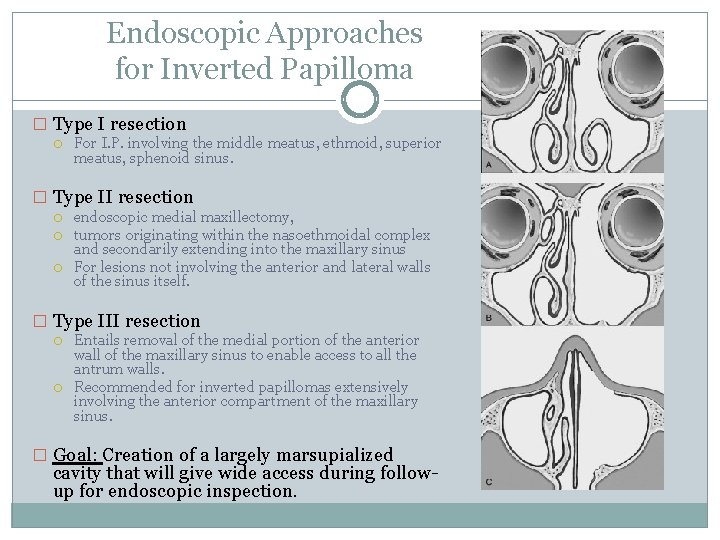 Endoscopic Approaches for Inverted Papilloma � Type I resection For I. P. involving the