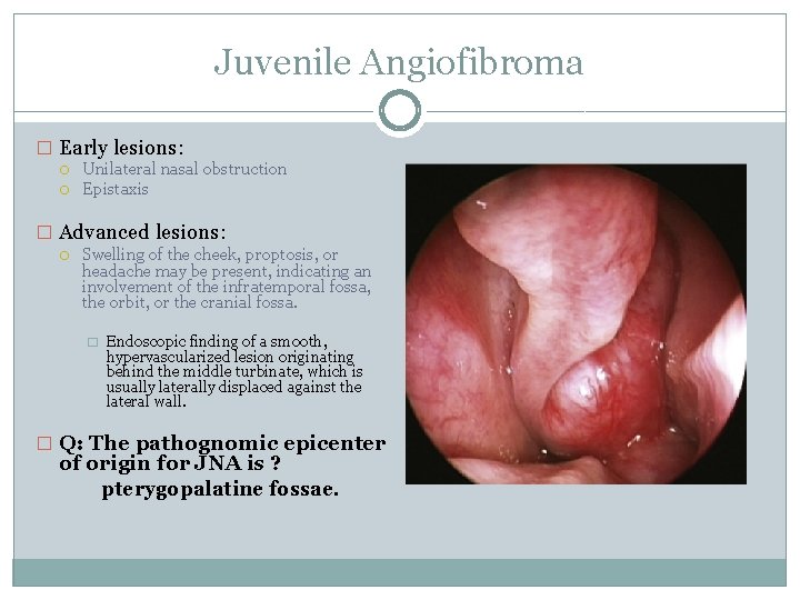 Juvenile Angiofibroma � Early lesions: Unilateral nasal obstruction Epistaxis � Advanced lesions: Swelling of