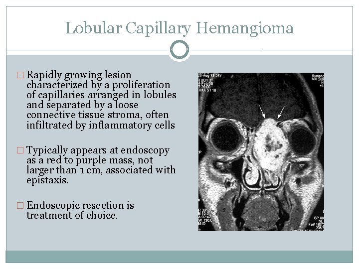 Lobular Capillary Hemangioma � Rapidly growing lesion characterized by a proliferation of capillaries arranged