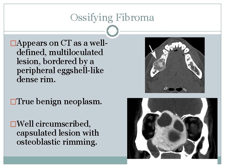 Ossifying Fibroma �Appears on CT as a well- defined, multiloculated lesion, bordered by a