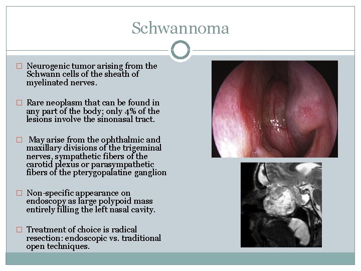 Schwannoma � Neurogenic tumor arising from the Schwann cells of the sheath of myelinated