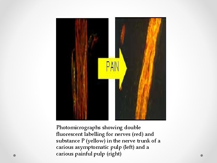 Photomicrographs showing double fluorescent labelling for nerves (red) and substance P (yellow) in the