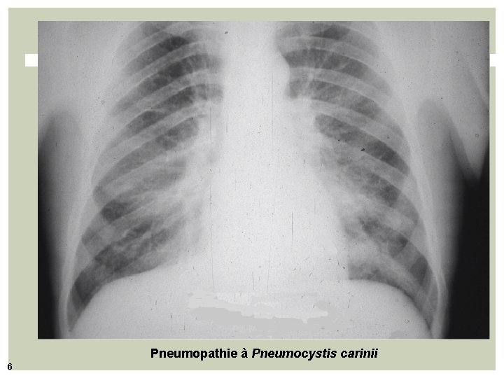Pneumopathie à Pneumocystis carinii 6 