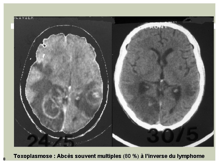 8 Toxoplasmose : Abcès souvent multiples (80 %) à l’inverse du lymphome 