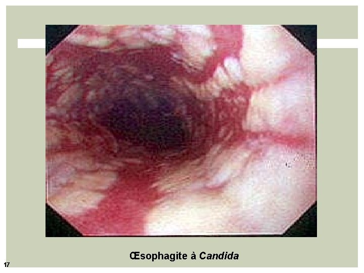 Œsophagite à Candida 17 