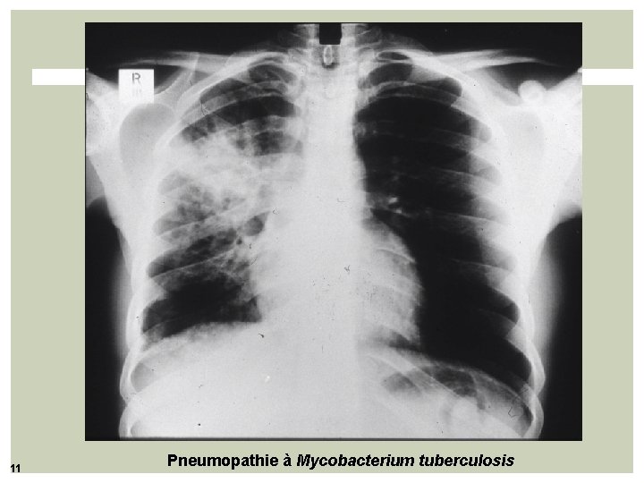 11 Pneumopathie à Mycobacterium tuberculosis 