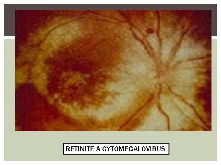 RETINITE A CMV RETINITE A CYTOMEGALOVIRUS 