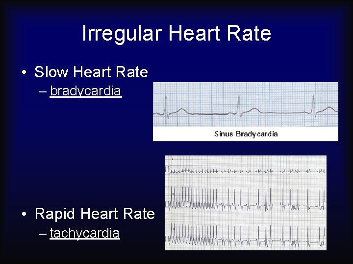 Irregular Heart Rate • Slow Heart Rate – bradycardia • Rapid Heart Rate –